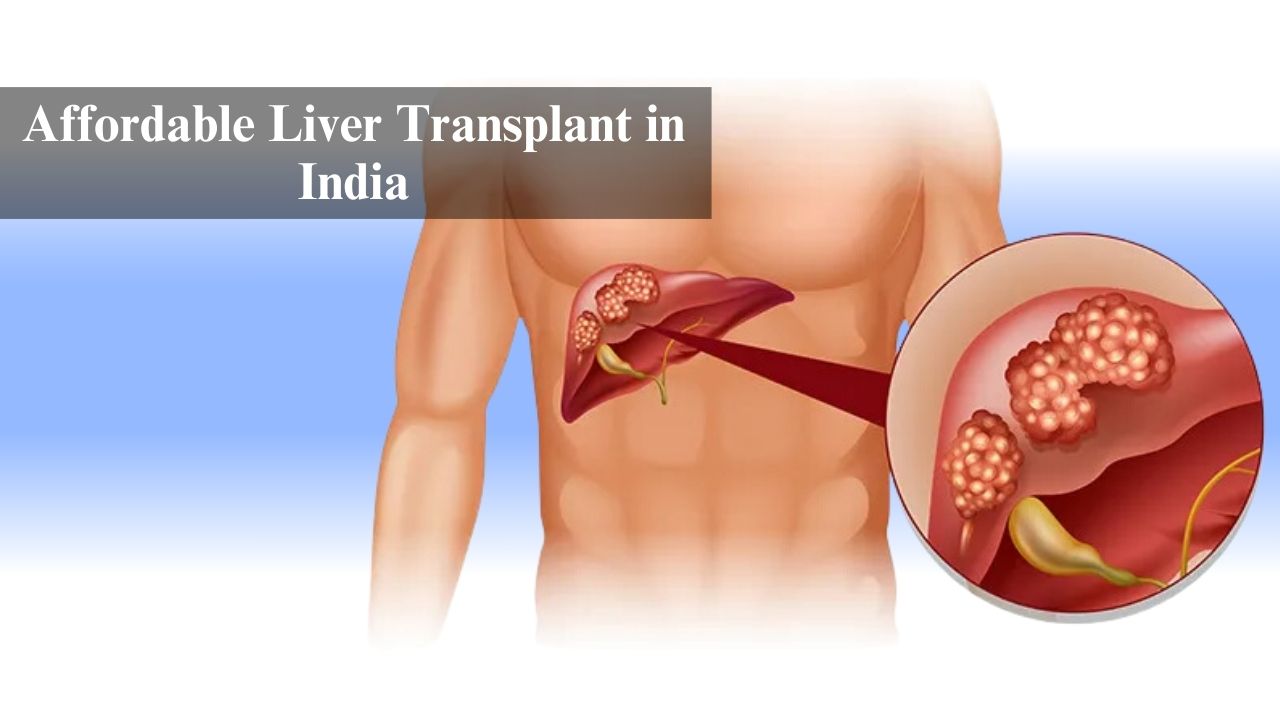 Affordable Liver Transplant in India