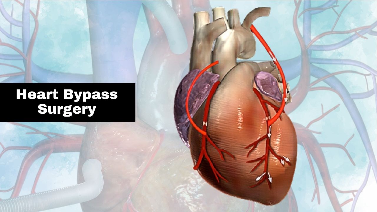 Heart Bypass Surgery Hospitals in India