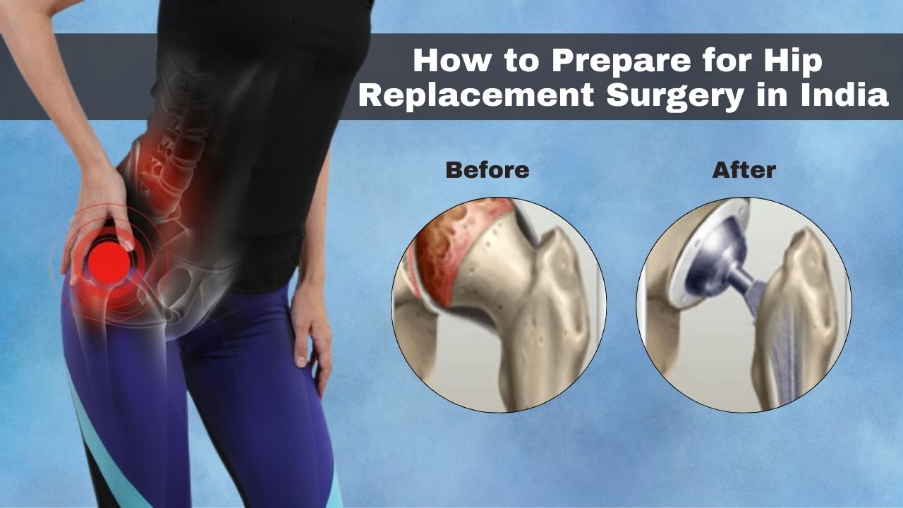 How to Prepare for Hip Replacement Surgery in India