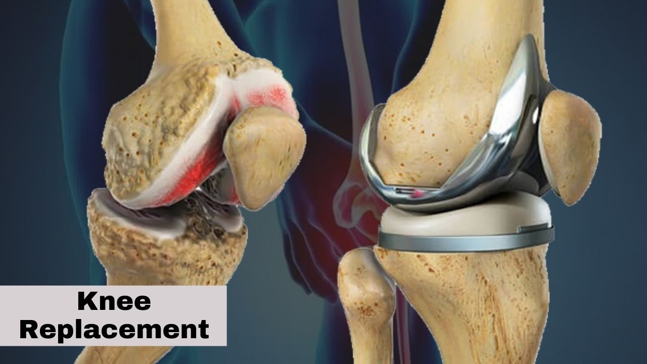 Knee Replacement Hospitals in India