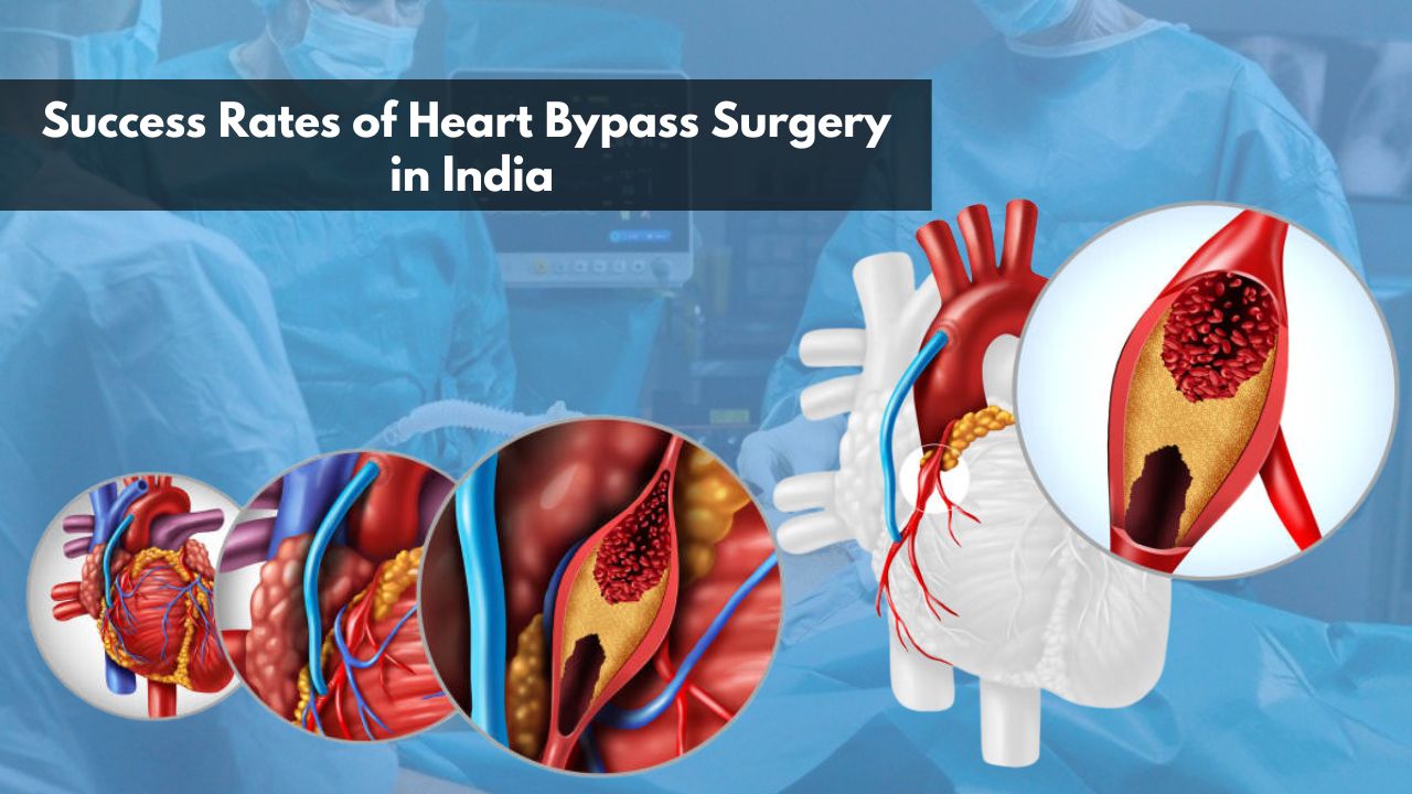 Success Rates of Heart Bypass Surgery in India